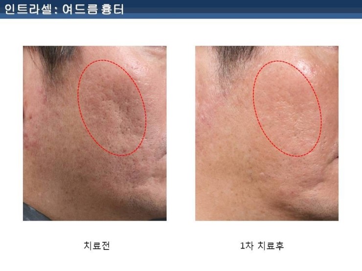 [잠실 연세힐피부과]여드름흉터 및 모공 치료의 새로운 강자 "인트라셀" 관련 이미지 6