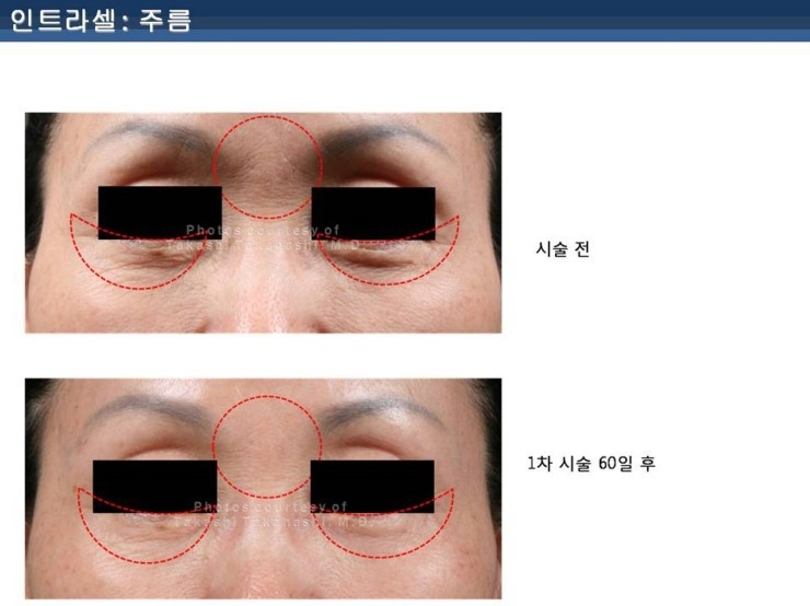 [잠실 연세힐피부과]여드름흉터 및 모공 치료의 새로운 강자 "인트라셀" 관련 이미지 10