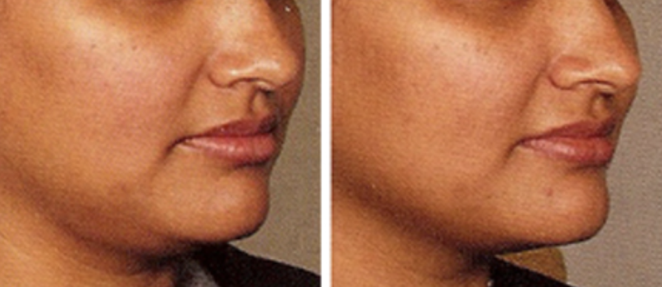 울쎄라 600샷 300샷에 수면 마취 필요할까요? 관련 이미지 1