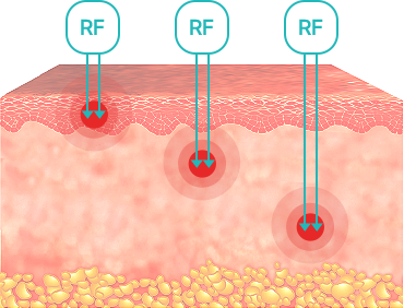 강남 포텐자, 모공 제대로 줄이고 싶다면 3가지 조건 알고 가세요 관련 이미지 6