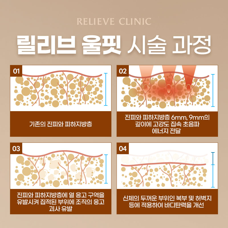 울핏 효과 유지기간 총정리 복부 팔뚝 바디리프팅 원리 관련 이미지 3