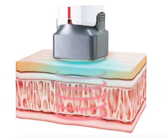 울쎄라vs세르프vs온다리프팅 차이 어떤 시술이 나에게 맞을까 관련 이미지 2