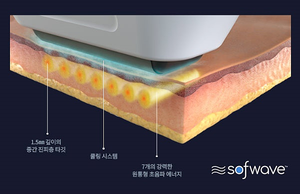 소프웨이브 리프팅 효과와 유지기간 울쎄라와 다른점 관련 이미지 2