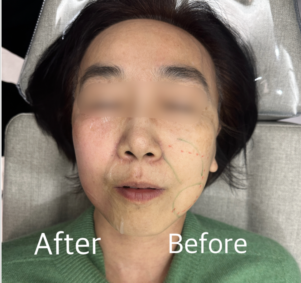 세르프 600샷 300샷 몇 샷을 받아야 할까 관련 이미지 1