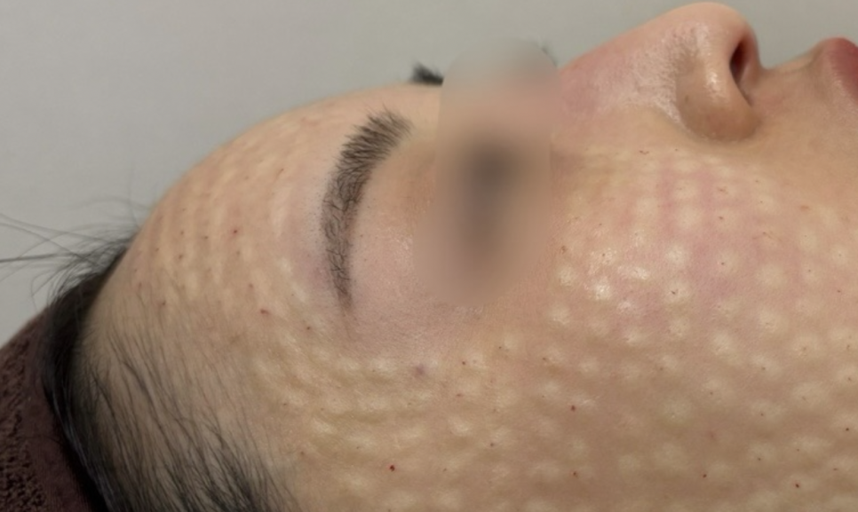 리쥬란 힐러 효과는 높이고 통증은 줄이는 방법 관련 이미지 4