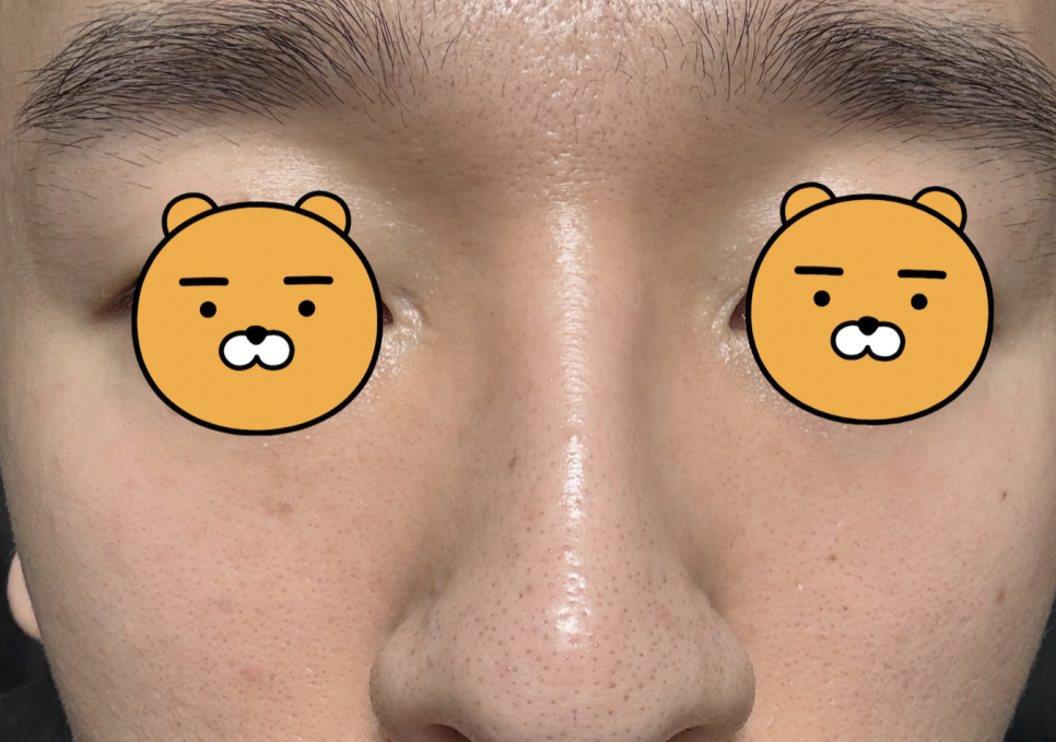 쥬베룩볼륨 결절 부작용 뭘 조심해야할까 관련 이미지 3
