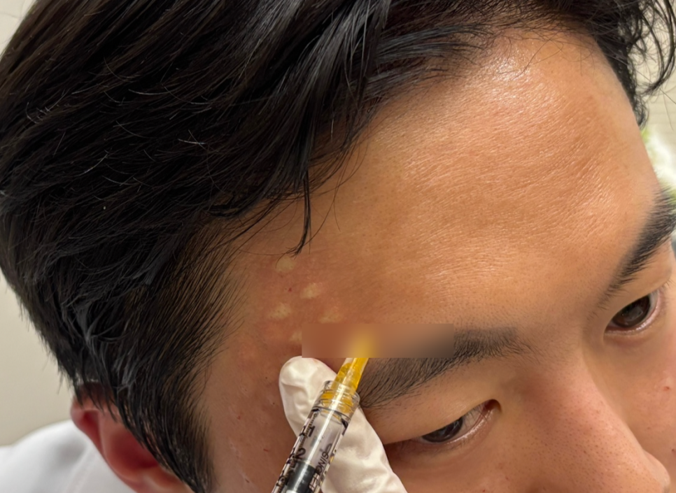 리쥬란 힐러 효과는 높이고 통증은 줄이는 방법 관련 이미지 1