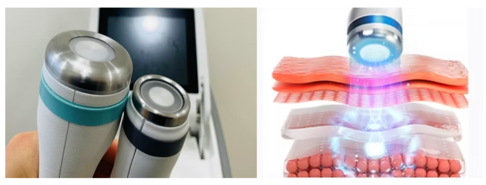 온다리프팅 울쎄라 통증비교 효과는 언제부터 나타날까? 관련 이미지 5