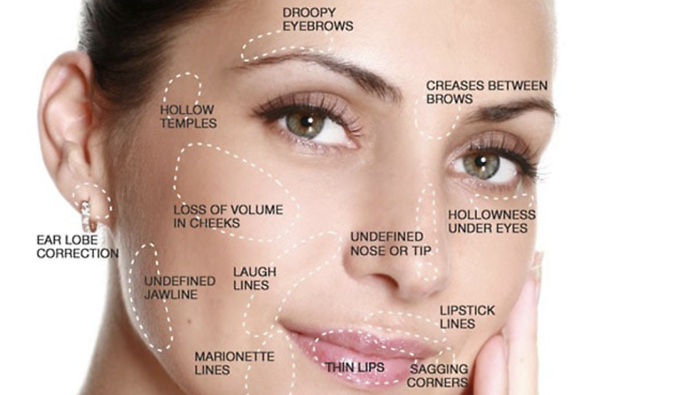 주베룩 볼륨, 필러는 무서우신 분들 관련 이미지 5