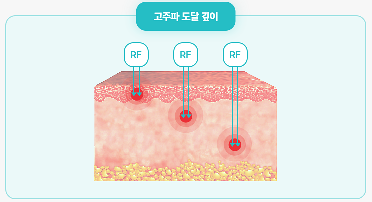 포텐자 효과 진짜 있을까? 모공 피부결이 바뀌는 이유 관련 이미지 5