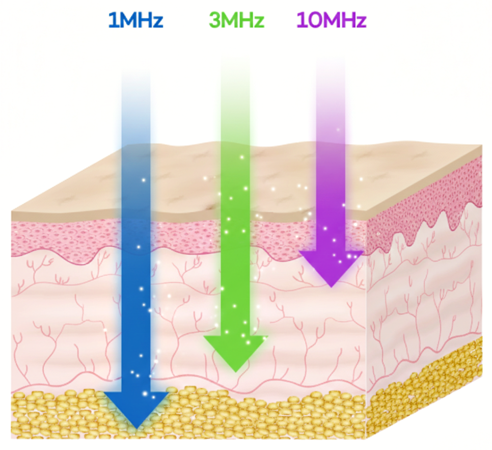 LDM 효과와 관리 분석 맑게 좋아지는 피부컨디션 관련 이미지 2