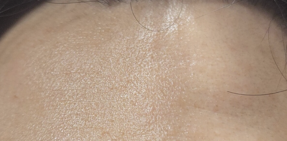 이마 스킨보톡스 효과와 시기, 잔주름 해결 방법 관련 이미지 2