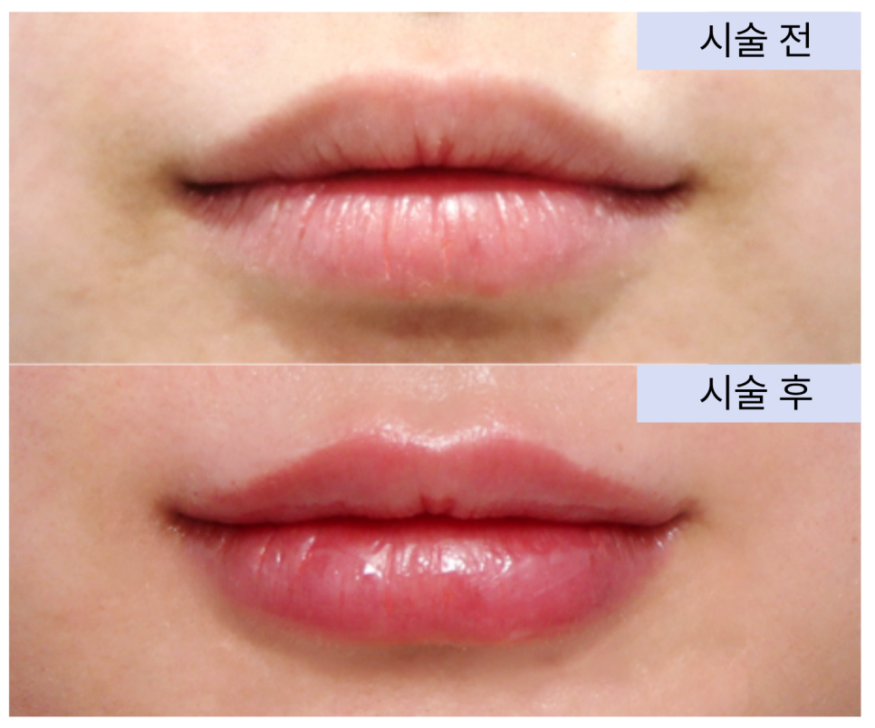 압구정 입술필러 선택과 유지기간 차이 필러1cc는 어떨까 관련 이미지 4