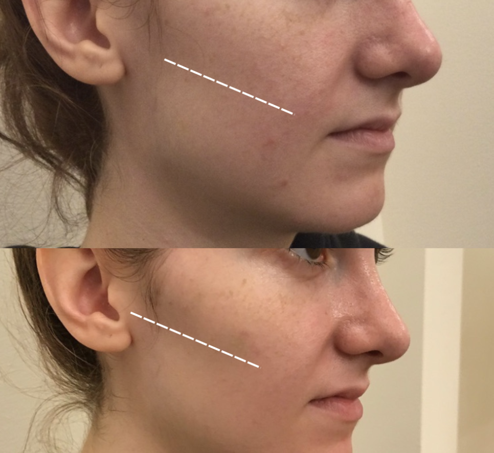 옆볼필러 2cc 붓기나 멍이 걱정되신다면 (+후기) 관련 이미지 3