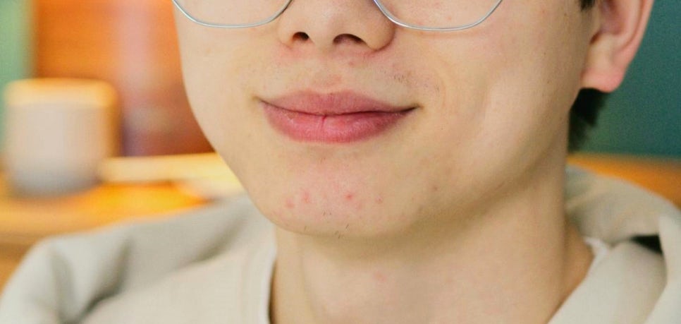여드름 피부관리 아직도 이렇게? 잘못된 상식 5가지 관련 이미지 3