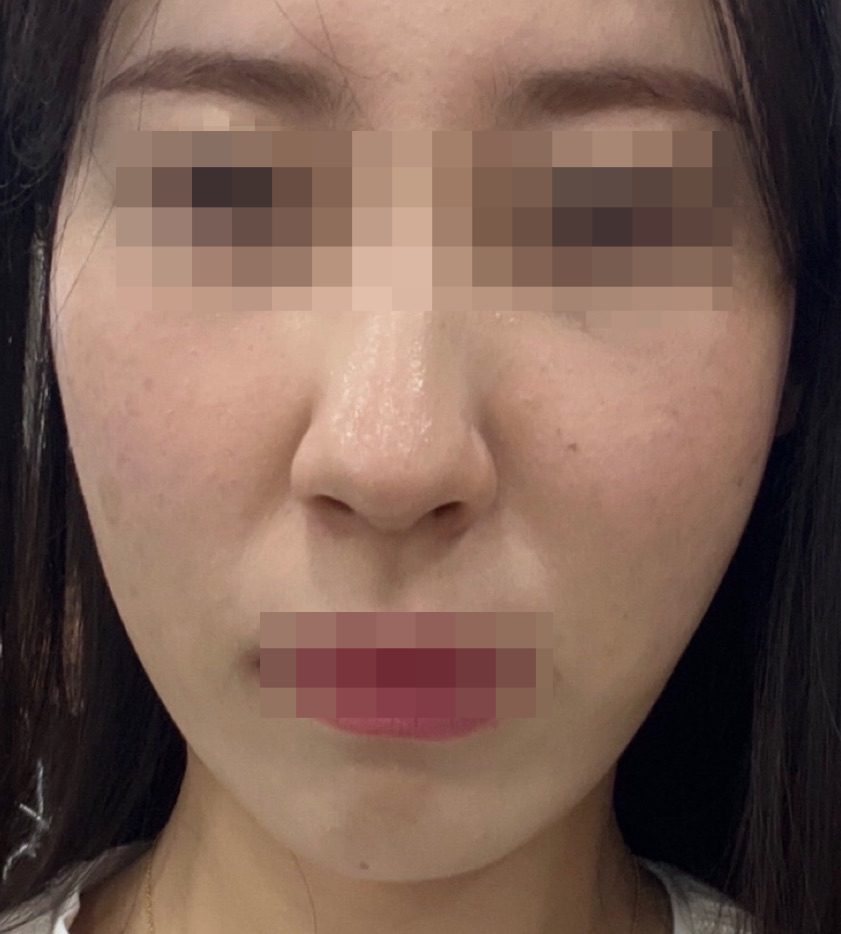 옆볼필러 2cc 붓기나 멍이 걱정되신다면 (+후기) 관련 이미지 5