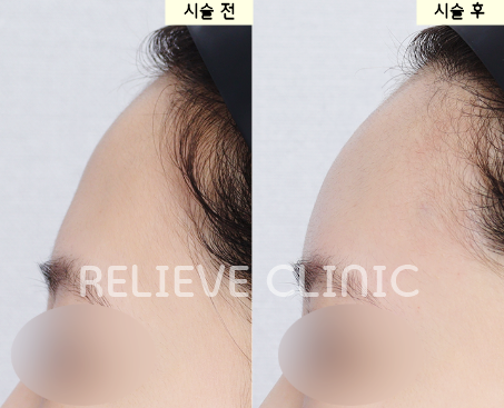 이마필러 왜 조금만 바꿔도 달라질까 필러선택기준 관련 이미지 4