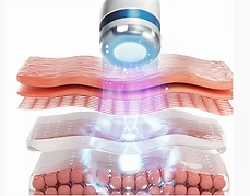압구정 온다리프팅 써마지 효과 시너지 올리는 방법 관련 이미지 5