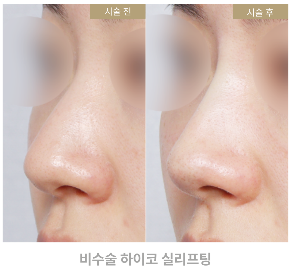 코실리프팅 궁금한질문 하이코 유지기간 부작용 총정리 관련 이미지 4