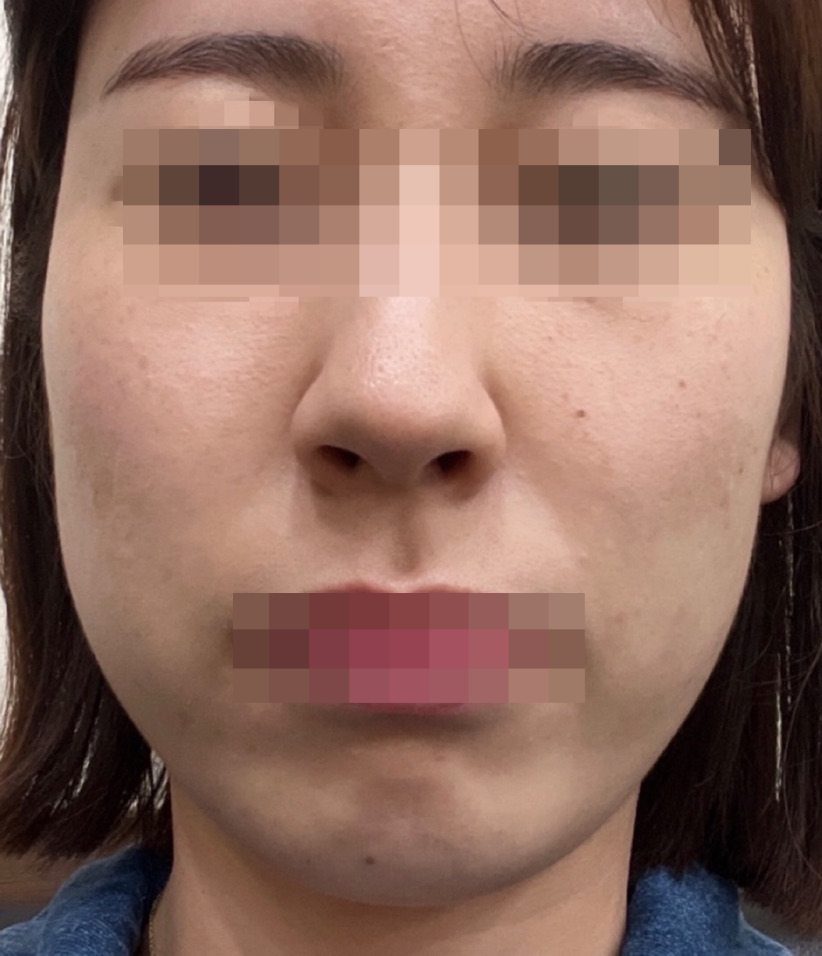 옆볼필러 2cc 붓기나 멍이 걱정되신다면 (+후기) 관련 이미지 4