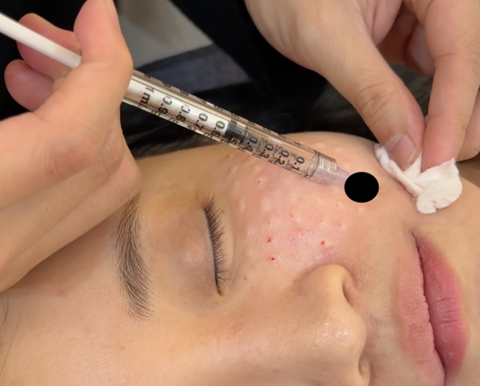 이마 스킨보톡스 효과와 시기, 잔주름 해결 방법 관련 이미지 4