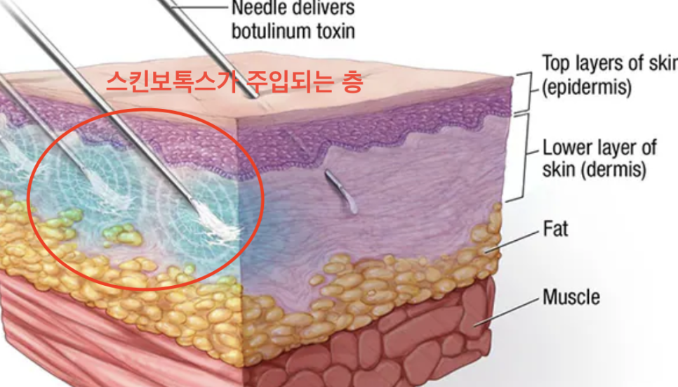 이마 스킨보톡스 효과와 시기, 잔주름 해결 방법 관련 이미지 1