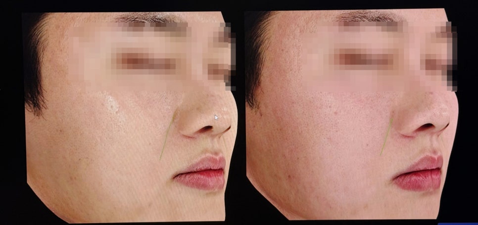 레디어스와 쥬베룩, 같은 콜라겐 스킨부스터일까? 관련 이미지 4