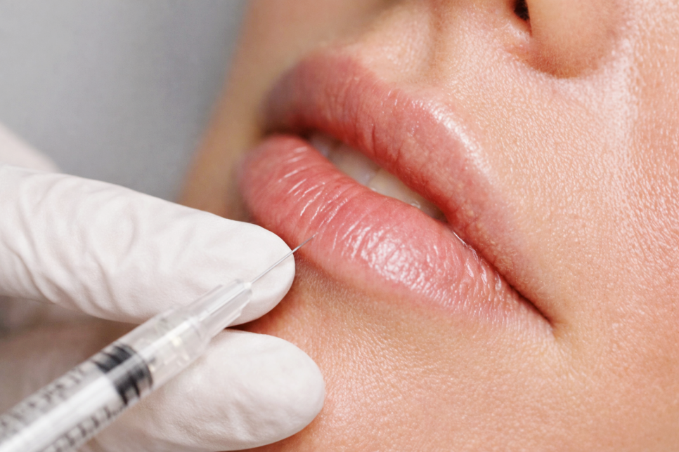 압구정 입술필러 선택과 유지기간 차이 필러1cc는 어떨까 관련 이미지 5