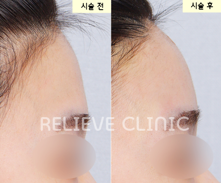 이마필러 왜 조금만 바꿔도 달라질까 필러선택기준 관련 이미지 2