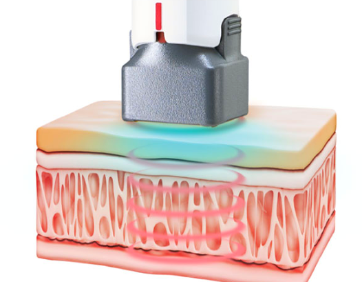 세르프 리프팅 효과와 통증까지 완벽정리 관련 이미지 4