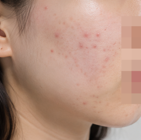 Recurrent Acne: Skin That May Benefit from Rejuran image 5