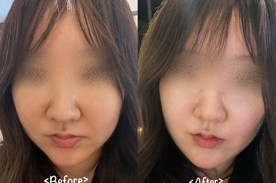 온다리프팅 효과 가격 몇 만줄이 적당할까 관련 이미지 1