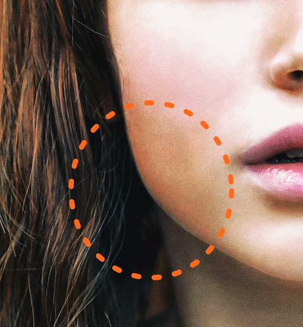 쥬베룩볼륨 붓기 결절 생기는 이유와 시술주기 관련 이미지 5