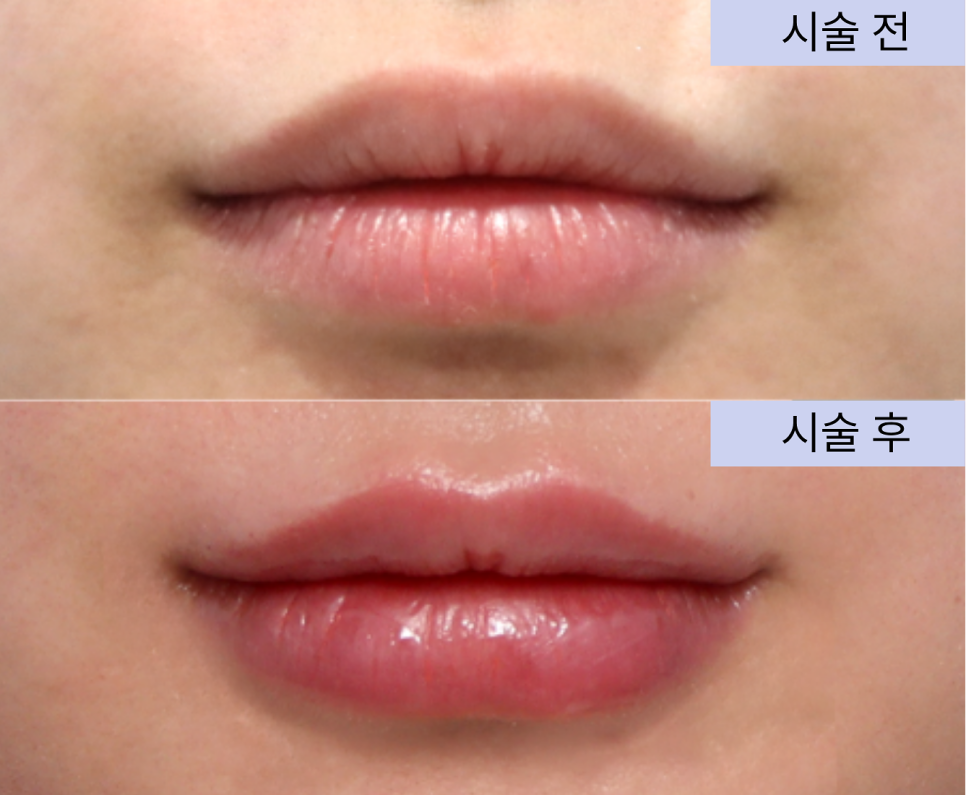 입술필러 1cc 전후 레스틸렌 쥬비덤 비교해서 추천 관련 이미지 3