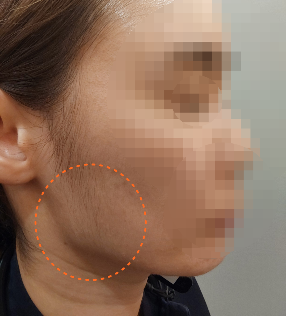 Differences in the Duration and Effects of Masseter Botox for Square Jaw image 3