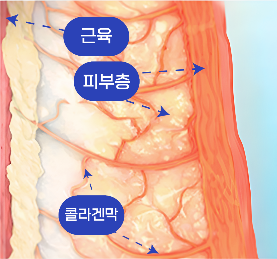 써마지 효과 피부에는 샷수가 정말 중요할까? 관련 이미지 3