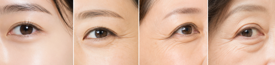 Eye Thermage: Can It Improve Fine Lines and Sagging Around the Eyes? image 4