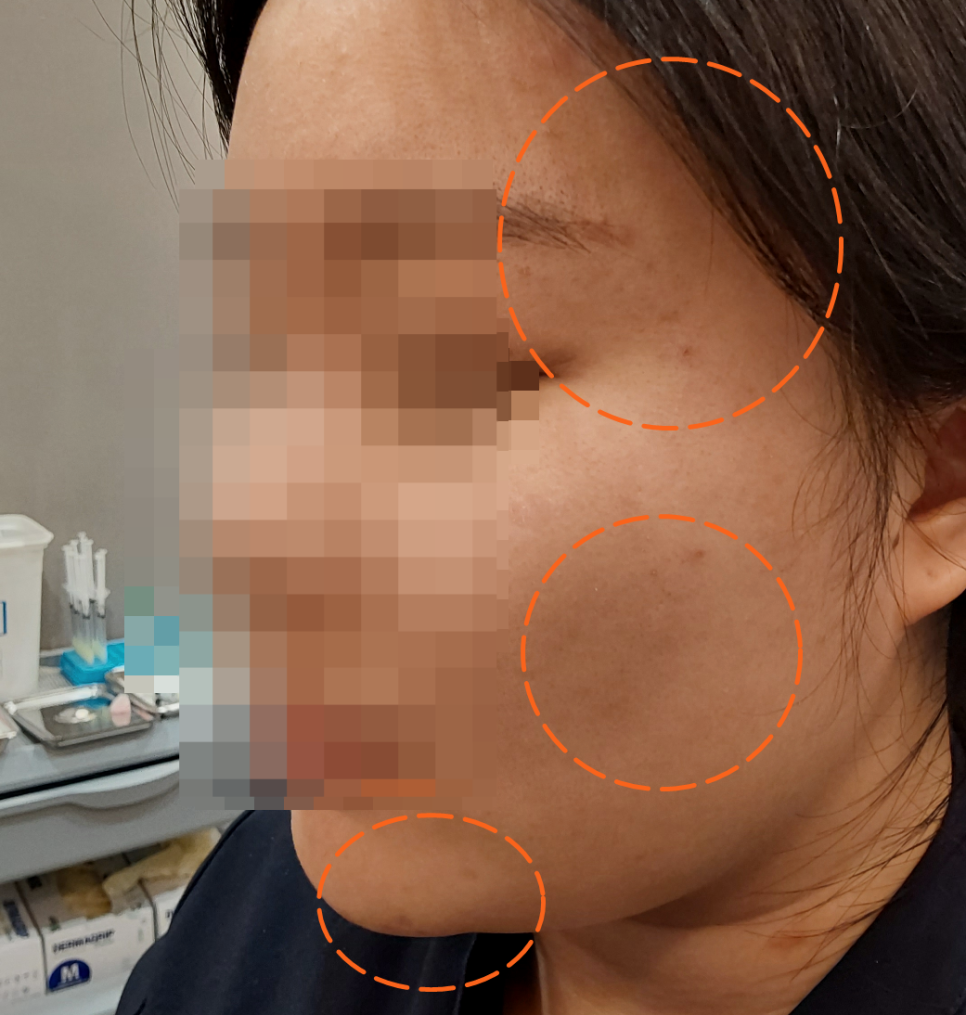 색소와 기미없애는법 피코토닝 레이저 효과가 있을까? 관련 이미지 1