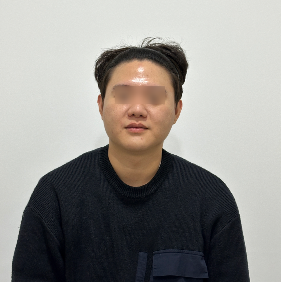 온다리프팅 효과 가격 몇 만줄이 적당할까 관련 이미지 2