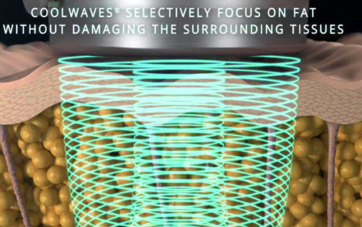 온다리프팅 10만줄 가격과 효과 몇 만줄이 적당할까 관련 이미지 3