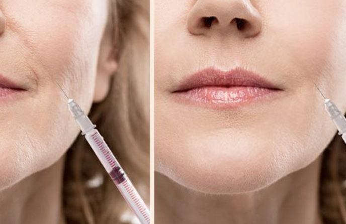 이마 스킨보톡스 효과와 시기, 잔주름 해결 방법 관련 이미지 3