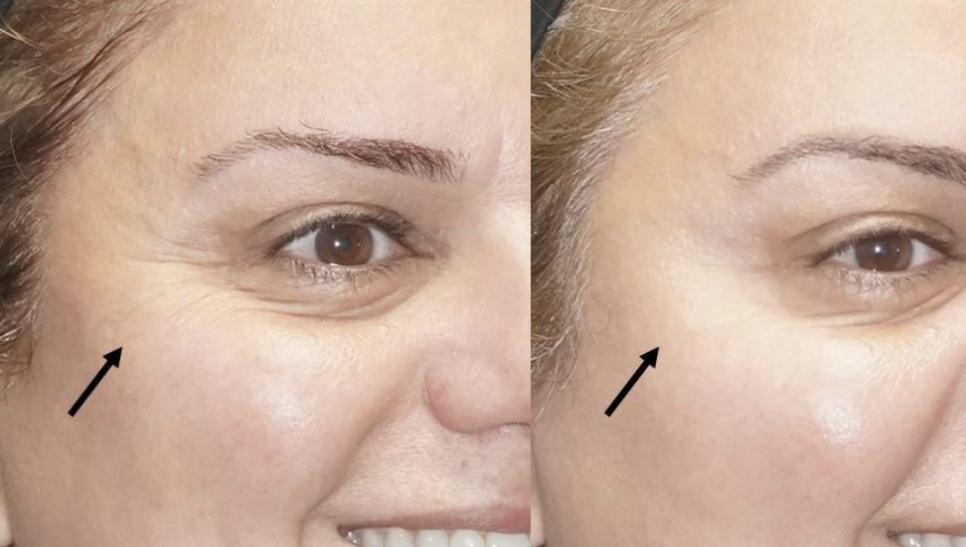 턱스킨보톡스 얼굴스킨보톡스 차이 관련 이미지 5