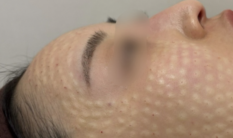 리쥬란힐러 효과 좋은 건 알죠? 리쥬란 시술 당일 엠보 관련 이미지 5