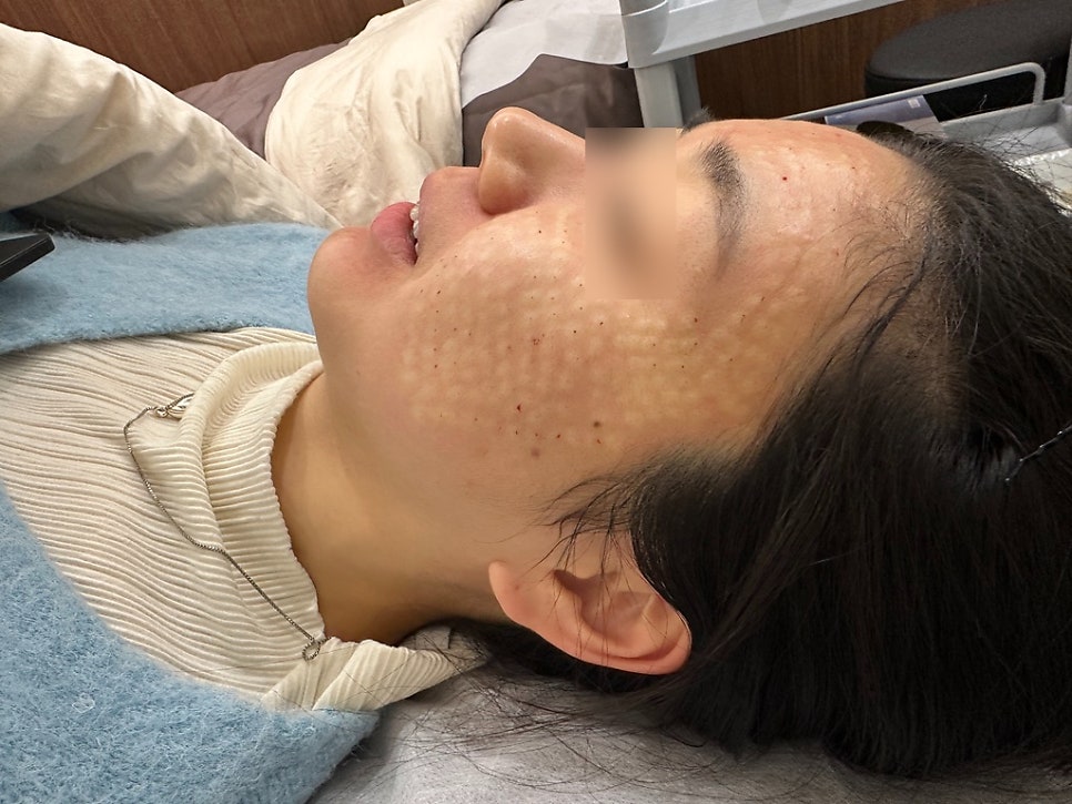 리주란 통증을 최소로 맞는 방법 관련 이미지 1