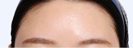 Please check this before getting glabella Botox: Causes of drooping eyelids and how to prevent it image 7