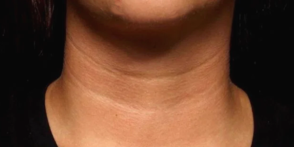 래디어스 효과 개선원리 목주름에 진짜 효과적일까? 관련 이미지 1