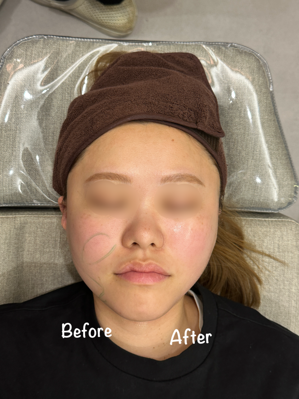 온다리프팅 10만줄 가격과 효과 몇 만줄이 적당할까 관련 이미지 1