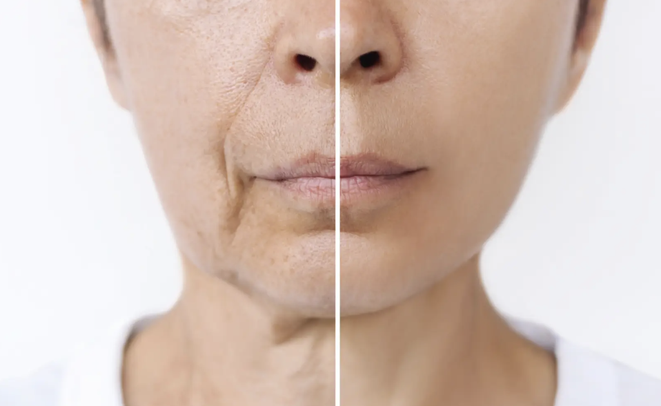 래디어스 시술 필러와 뭐가 다를까 관련 이미지 2