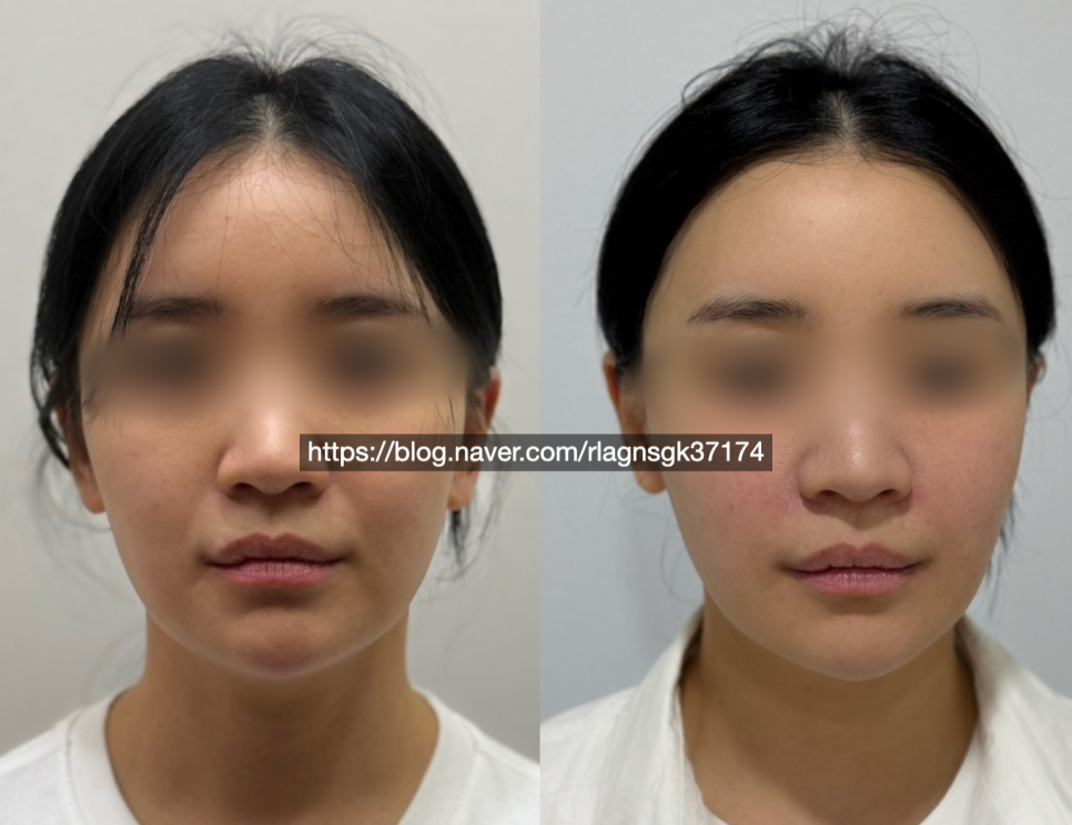 래디어스 시술 필러와 뭐가 다를까 관련 이미지 1