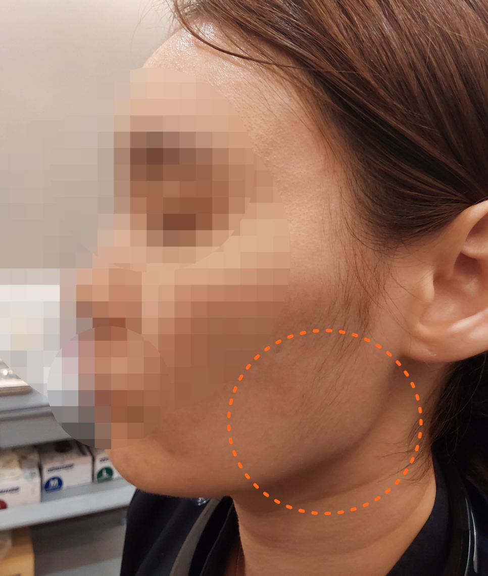 Differences in the Duration and Effects of Masseter Botox for Square Jaw image 2